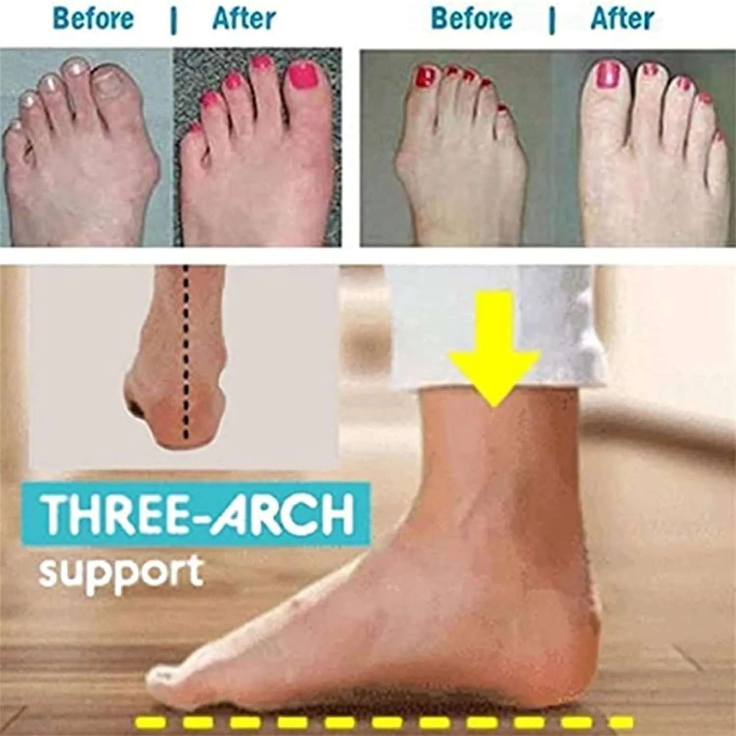 Bunion Correction Sandals, Women's Comfy Hollow Wedge Heels Slip-On Bunion Corrector Slippers, Open Toe Breathable Casual Travel Shoes, for Flat Feet and Plantar Fasciitis Orthopedic